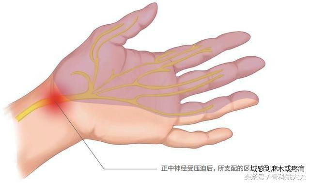 手指麻木怎么办？手指麻木的病因是什么？医生告诉你答案