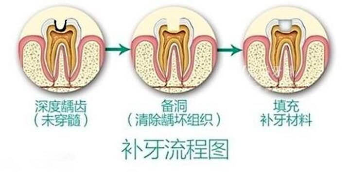 牙齿龋坏后需补牙，补牙材料选哪种好？牙医教你选便宜又好用的