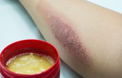 偏方害人：面粉、牙膏、酱油、醋…不治烧烫伤，别再继续被骗了