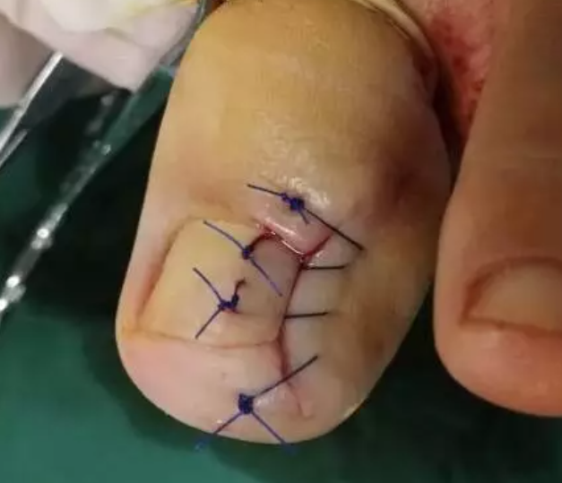 很多人的「甲沟炎」,其实都是自己剪指甲剪出来的