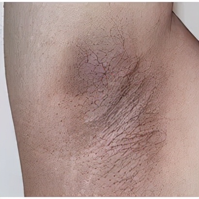 为什么手肘总是黑黑的?