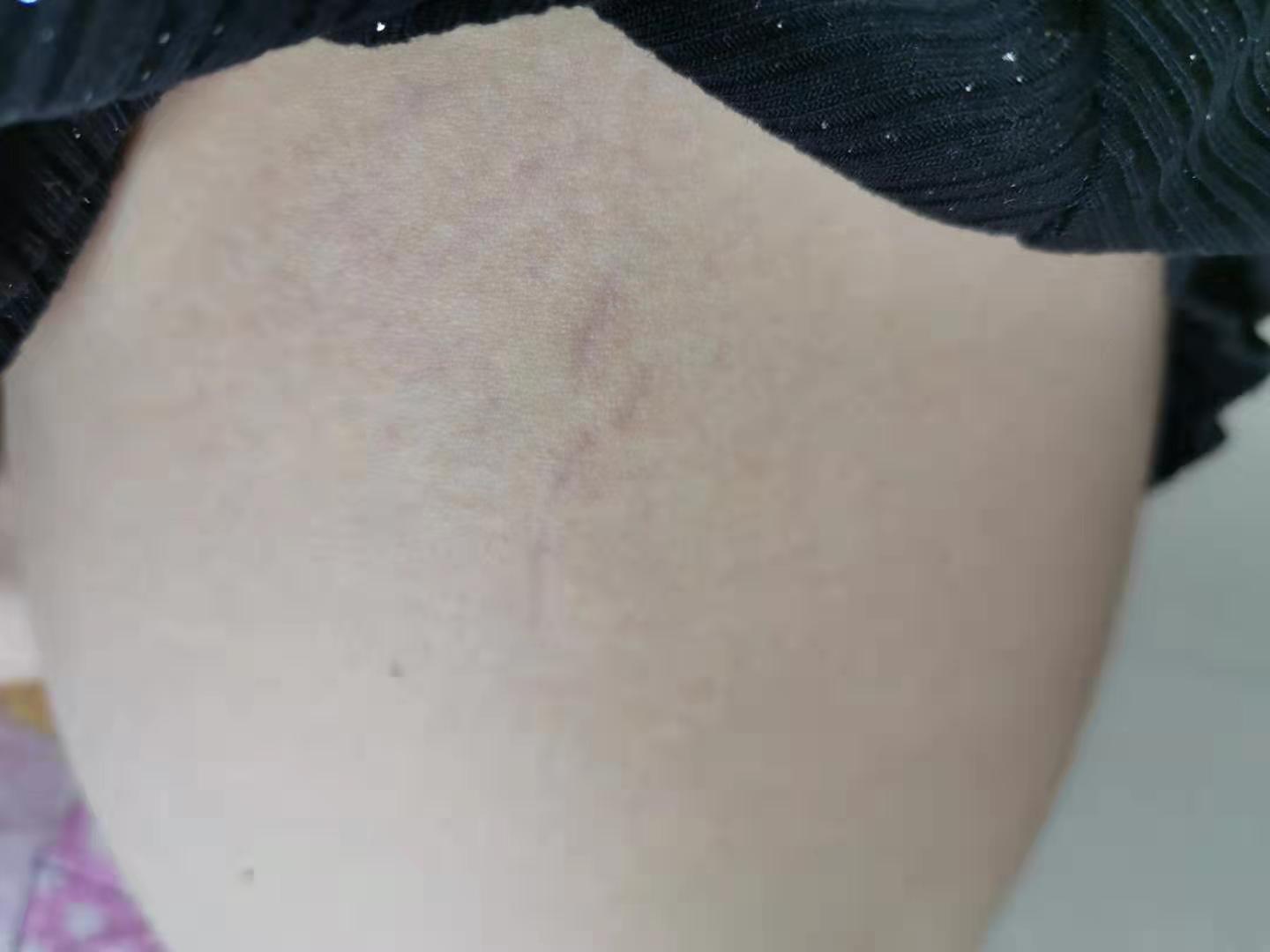 淡化妊娠纹的好产品（去除和修复妊娠纹的好物测评）