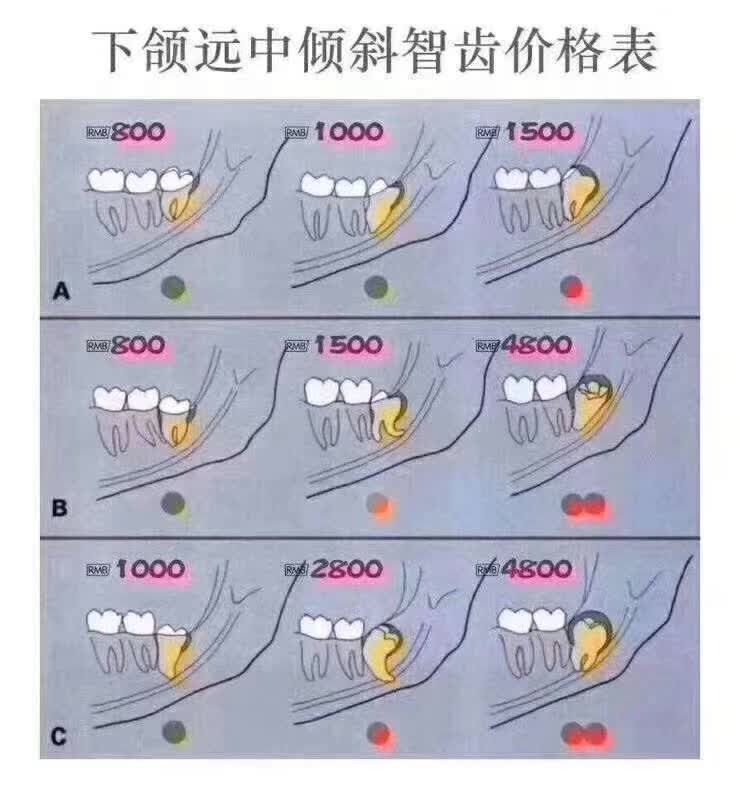 埋得越深，分手费越高—你所不知道的拔智齿收费依据