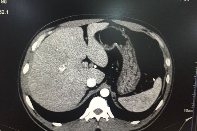 做一次CT，对人的影响到底有多大？医生说出了心里话