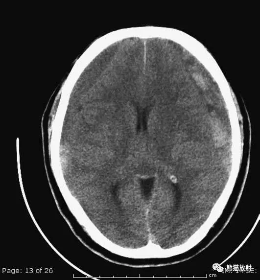 简明又详细的头部CT读片详解，收藏
