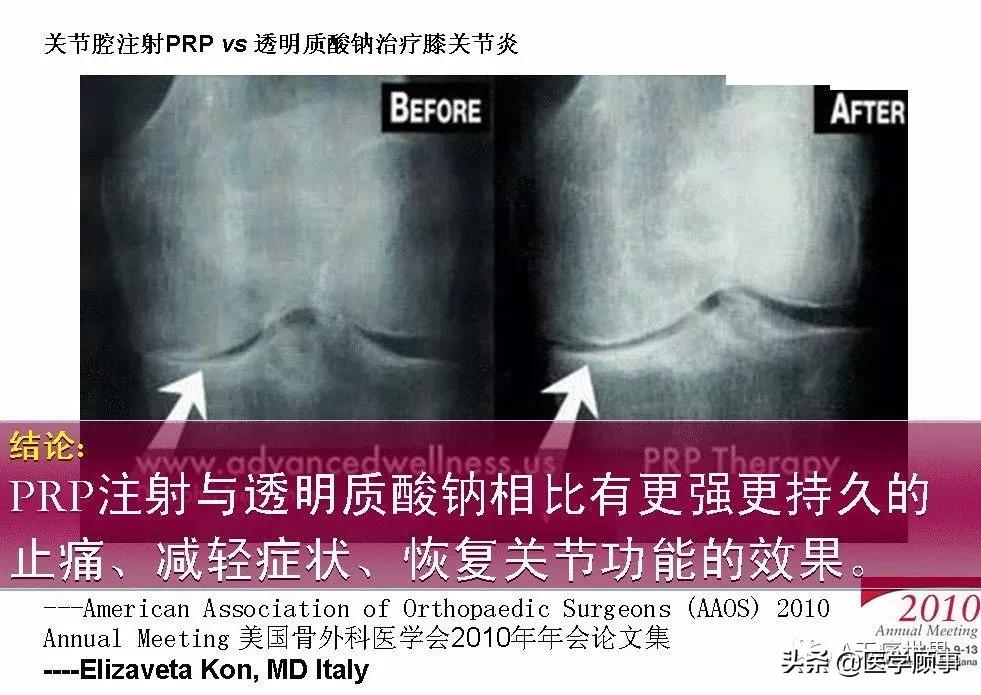 PRP治疗膝关节骨性关节炎