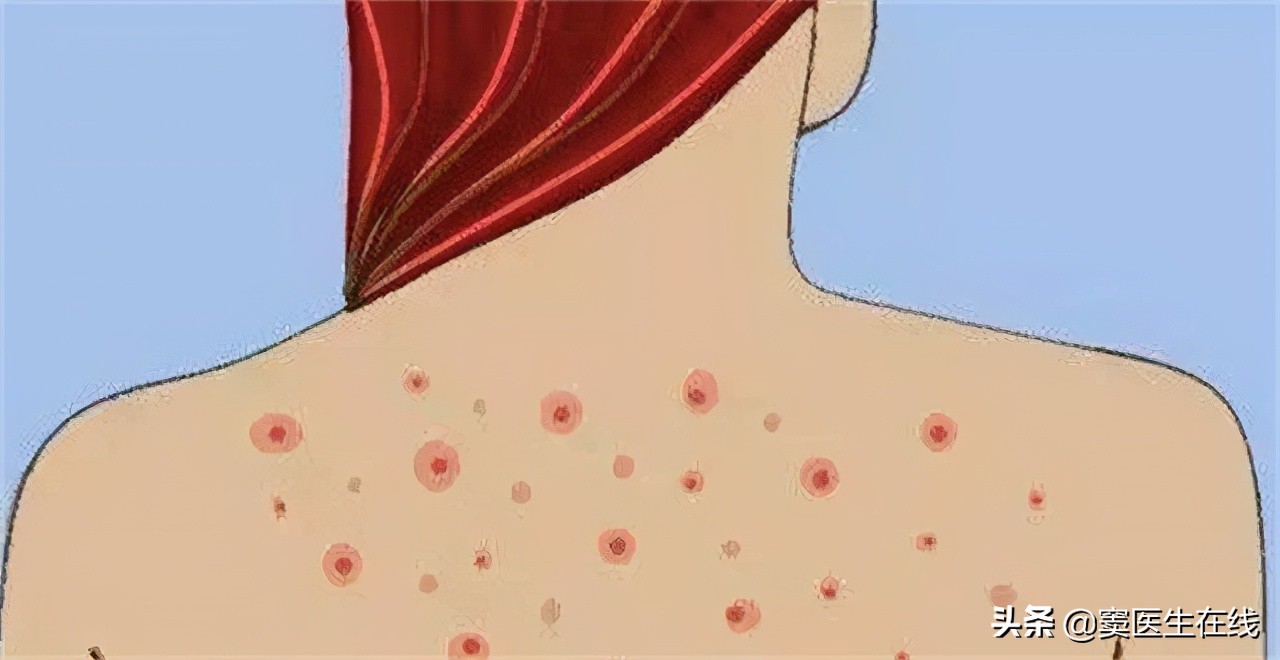 都是以大面积的方式出现,在刚开始的时候呈针头大小的白色脓包丘疹,若