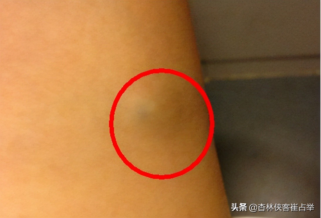 身上有脂肪瘤怎么办？医生告诉你不要担心，用这两味药可以消掉