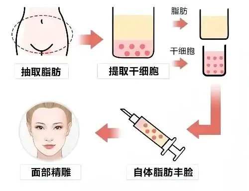 可用于面部填充的材料都有哪些?