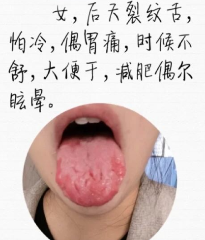 舌头有裂纹是怎么回事？常见的裂纹舌辩证，看看你是哪一种？