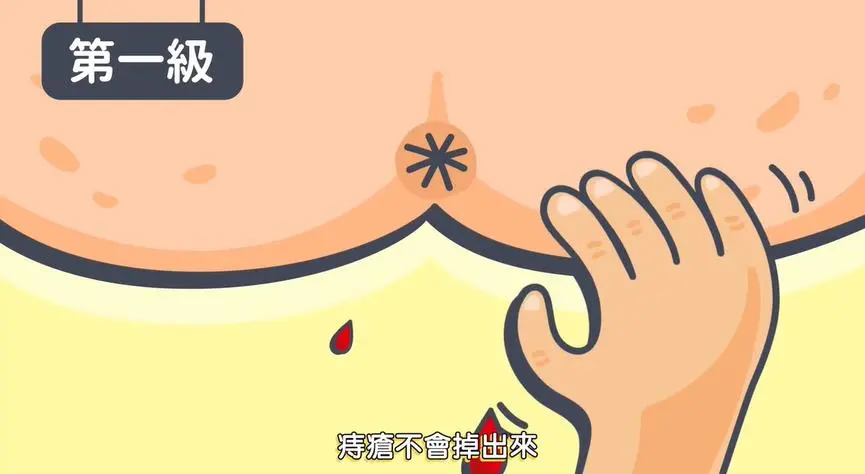 便秘+痔疮,千万别自行用药,当心越用越糟