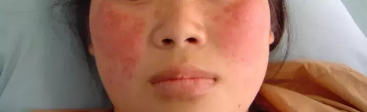 狼疮红斑是什么病（红斑狼疮的主要症状介绍）