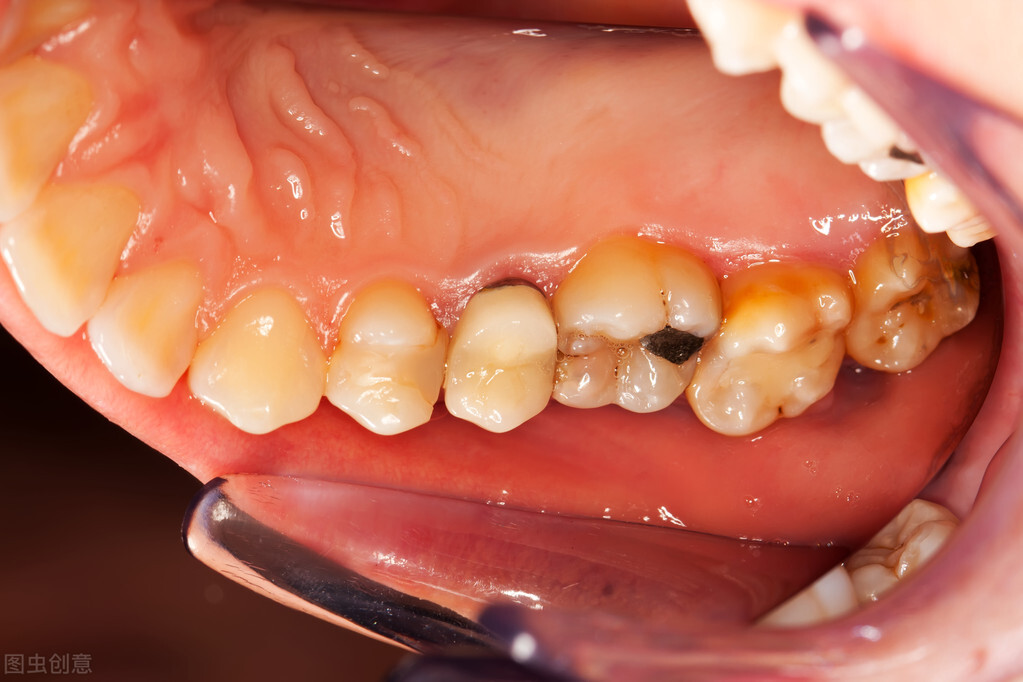 牙龈发炎怎么办 牙龈发炎吃什么药最管用 - 汽车时代网