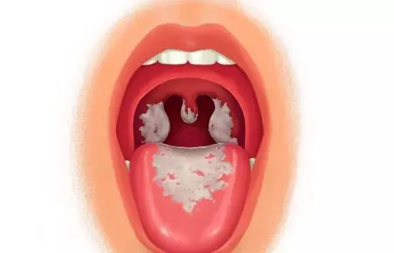 的皮革白喉(diphtheria)是由白喉杆菌所引起的一种急性呼吸道传染病