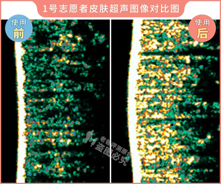 网红家用美容仪真的有效吗？2个多月的跟踪实测结果来了
