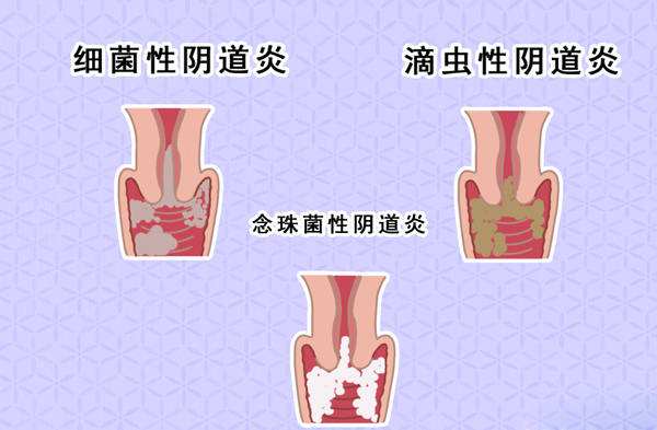 你知道妇科常用的甲硝唑怎么用最有效吗？用时该注意什么？