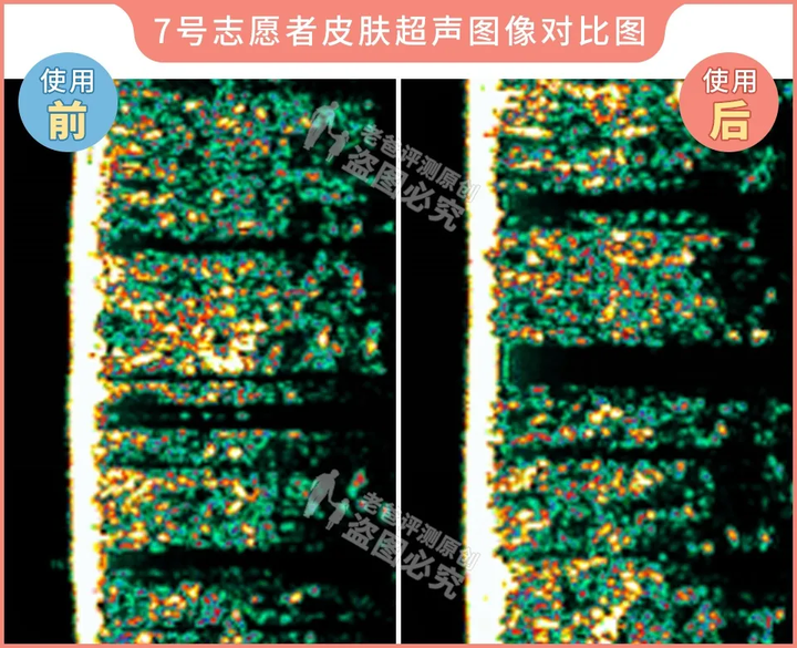 网红家用美容仪真的有效吗？2个多月的跟踪实测结果来了