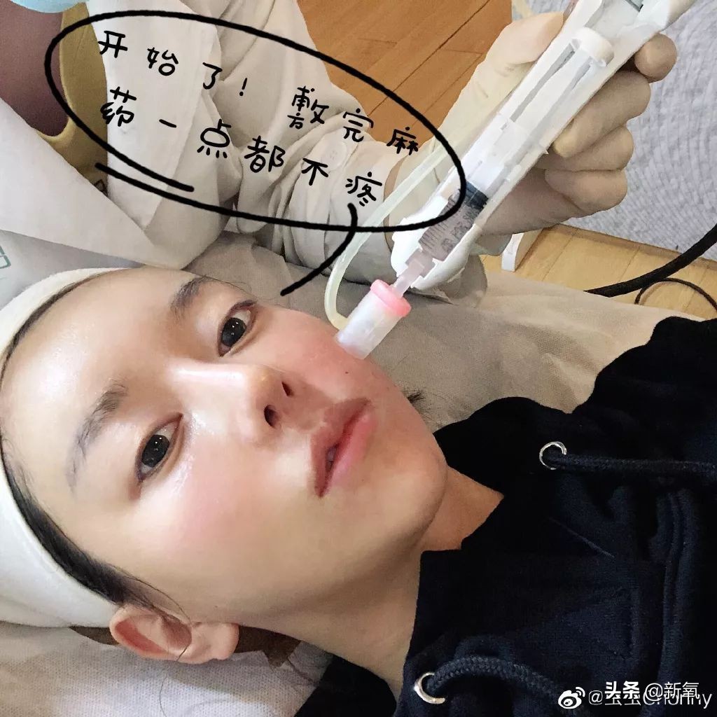 因小丑妆爆红的美妆扛把子，分享整形经历圈粉，而真人山根太假