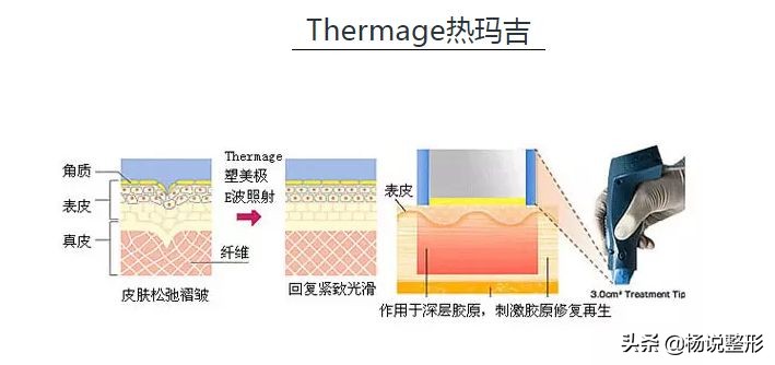 连黄子韬、虞书欣都青睐的热玛吉，到底多少岁才需要去做？