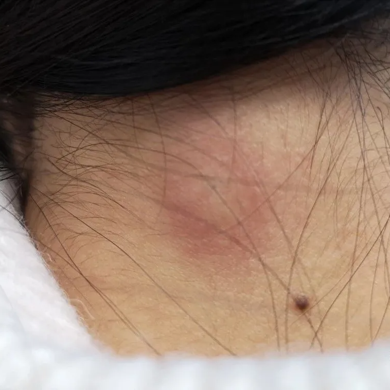 皮脂腺囊肿 皮脂腺囊肿癌变的前兆-世界十大百科