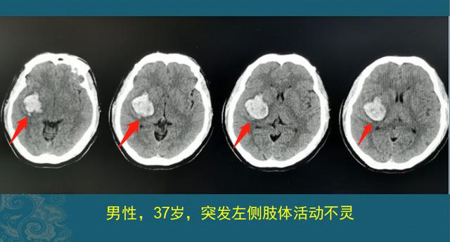 长年吃降压药副作用大？这2位病人后悔没吃药，没有后悔药了