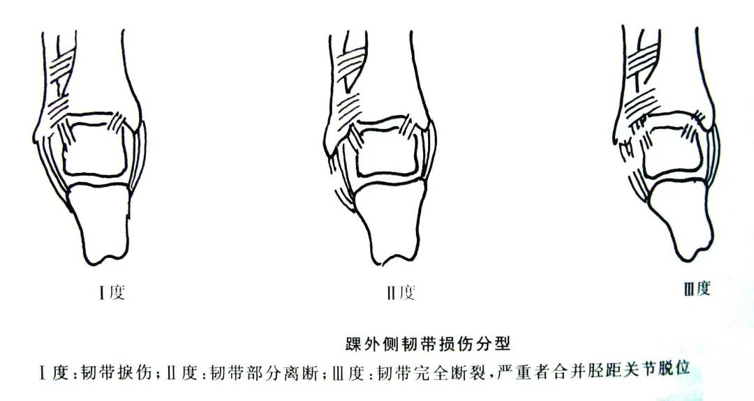体能康复 | 崴脚也有很多种不同的情况