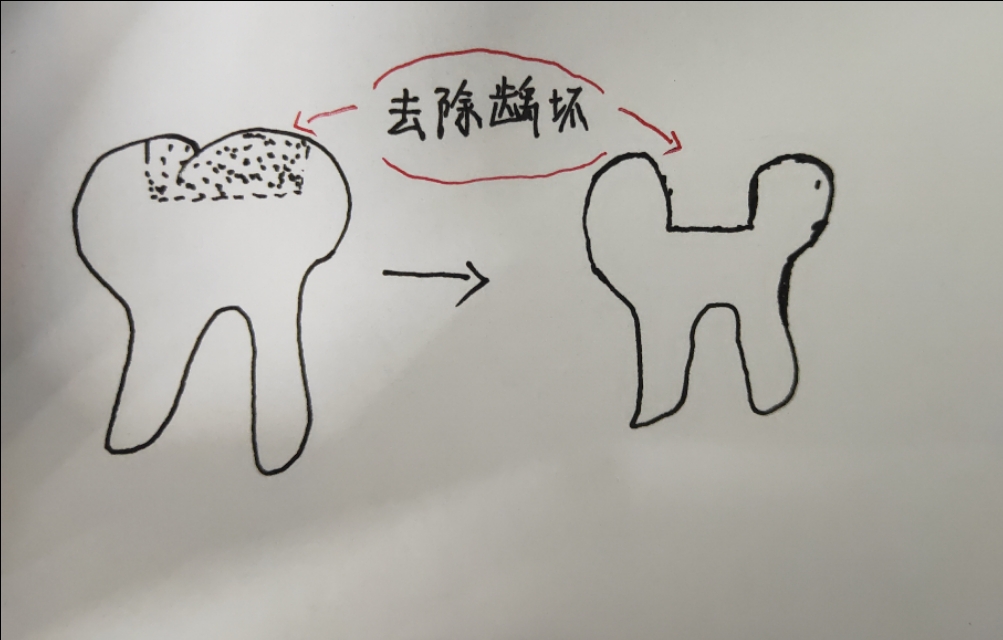 蛀牙出现黑洞怎么办？口腔医生手绘图解详细说明治疗步骤与日常护理方法