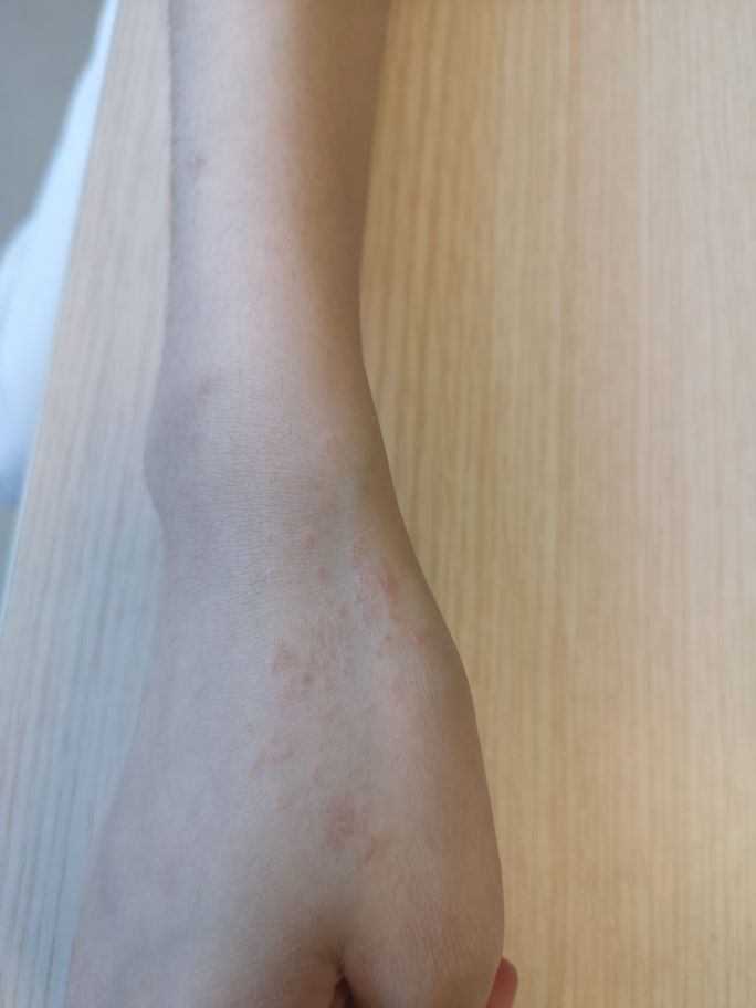 初级苔藓皮肤病图片(长成一条线的就是线状苔癣) - 赤虎壹号