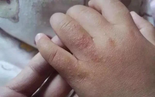 沙土皮炎又叫摩擦性苔藓样疹,儿童丘疹性皮疹,肘膝复发性夏季糠疹.