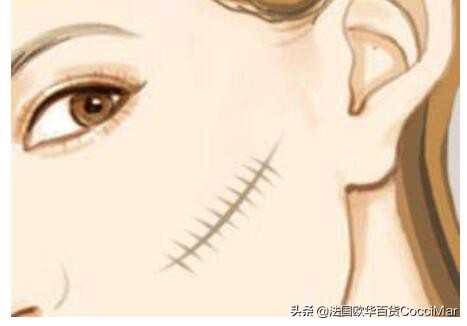 怎能讓疤痕破壞你的美 祛疤產品排行榜