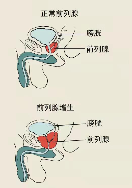 前列腺增生的治疗方法以及秋季预防措施