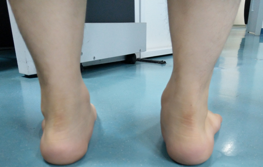 踢足球会变扁平足吗(5分钟带你认识"扁平足",附扁平足训练方法)