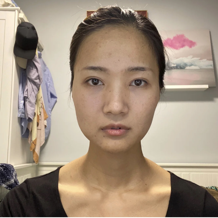 “大小脸”会影响颜值，来看看是怎样改善的，越早知道越好