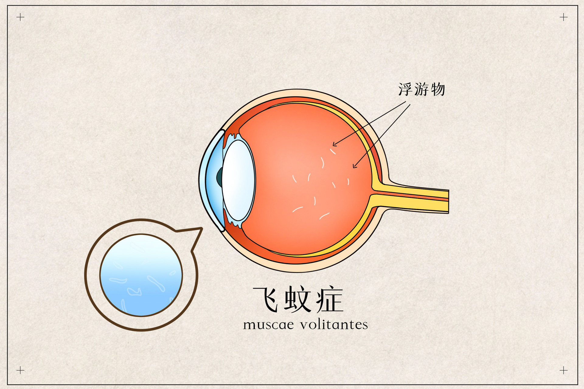 吉卡生物 |干细胞让“飞蚊症”重拾光明