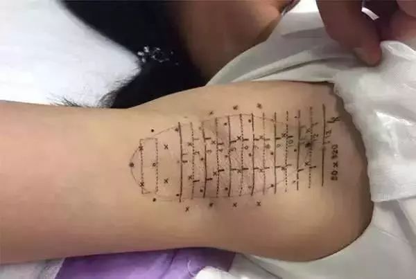 腋臭治疗过程大揭秘，有图有真相