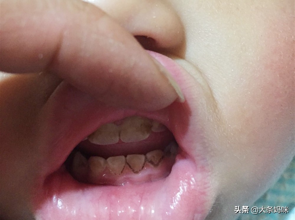 婴儿牙床发黄图片(19个月男孩牙齿变黄) 