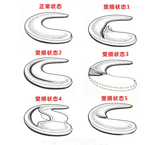 半月板损伤要手术，半月板缝合、成型、切除，哪种手术效果好？