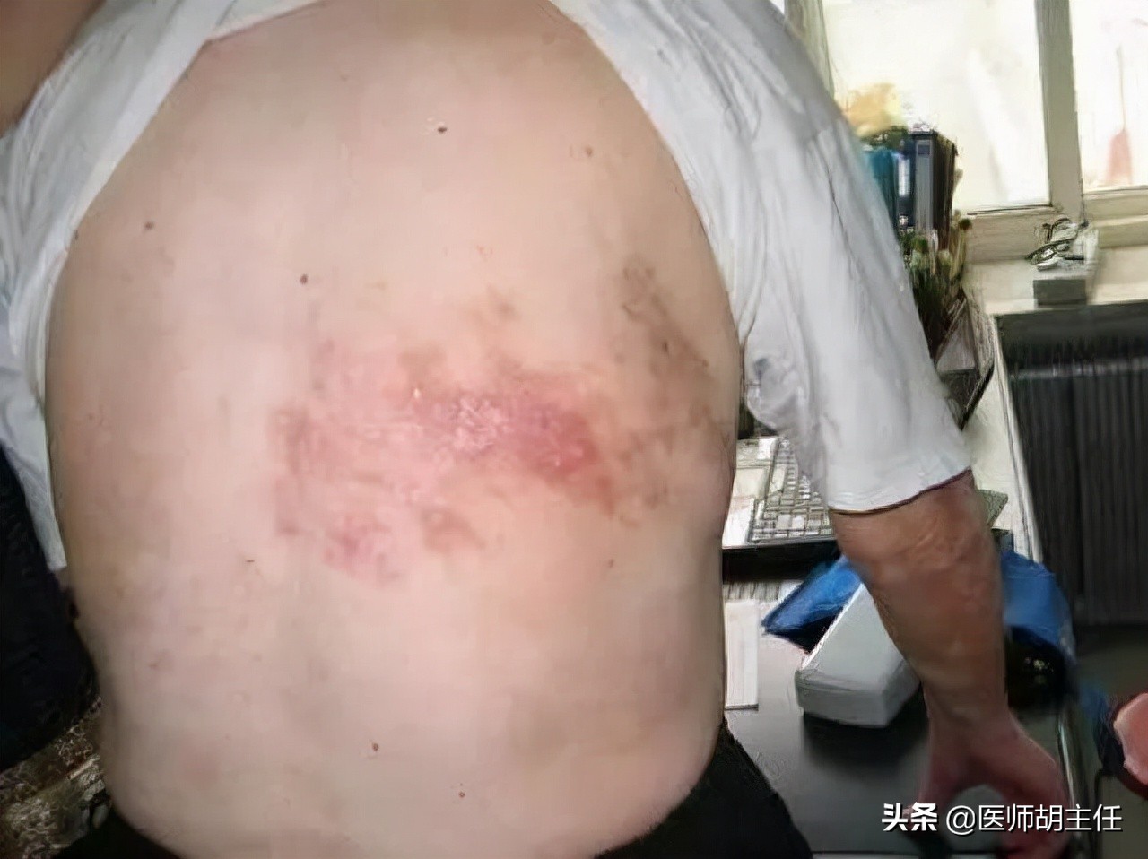 甲钴胺不仅能修复受损神经，还能用于这几种常见病的治疗，好用