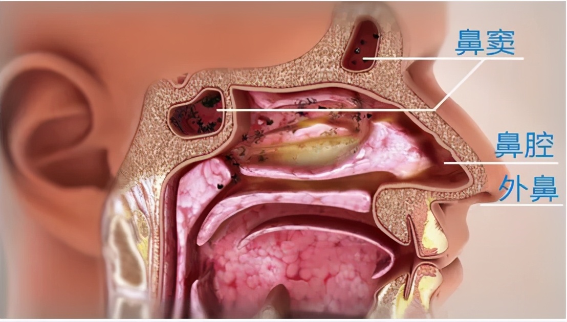 正常鼻子与鼻炎图片图片