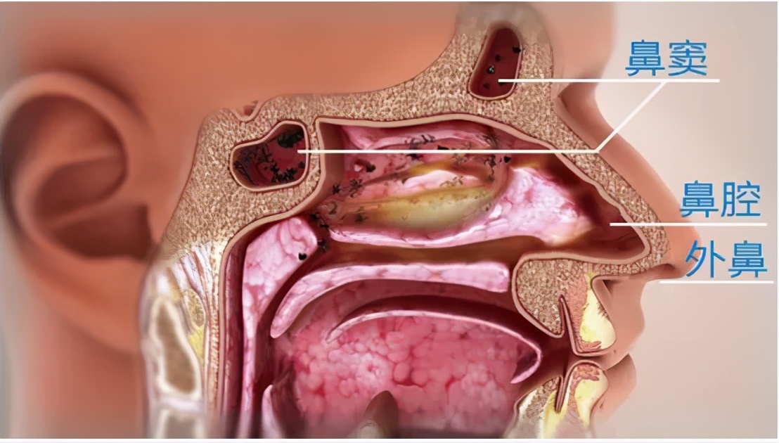 鼻炎与鼻窦炎的区别