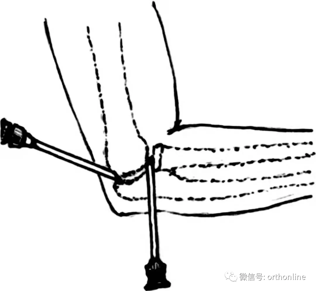 临床实用 | 关节穿刺技术分享