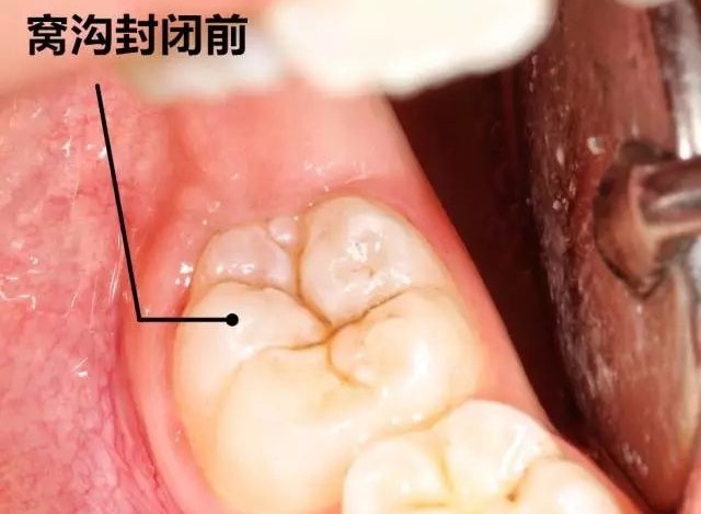 90%的孩子都有蛀牙：别再让孩子补牙，这个方法更有效