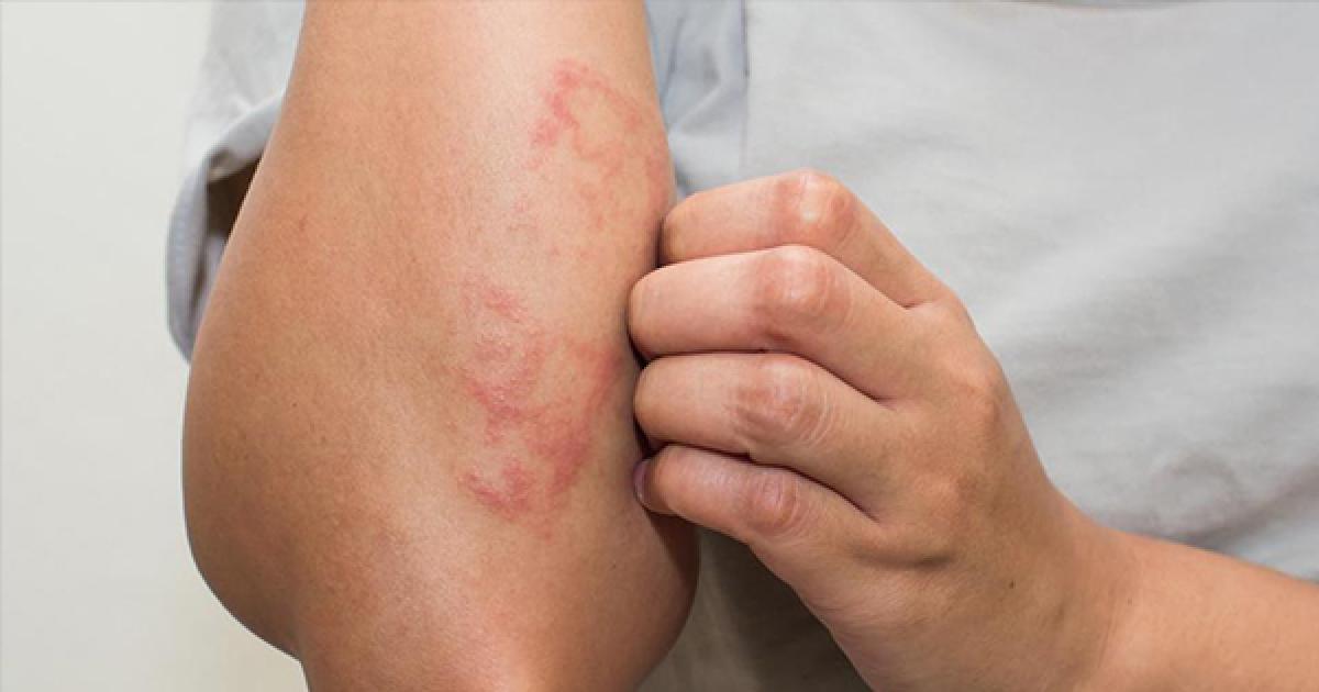 增殖型天疱疮的患者,皮肤症状明显,可能跟遗传有关,早些就医