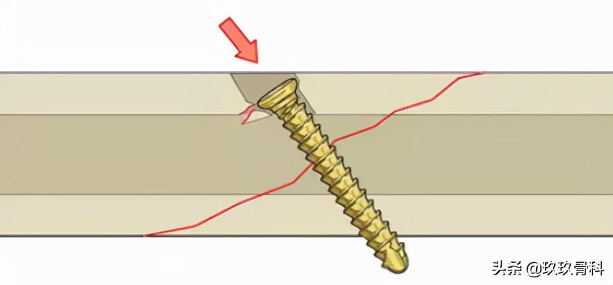 拉力螺钉使用的小技巧