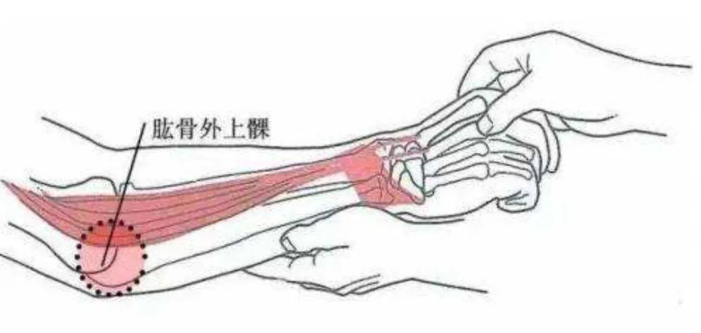 網(wǎng)球肘的癥狀如何治療（有一種胳膊痛叫“網(wǎng)球肘”！送上治療全攻略①）