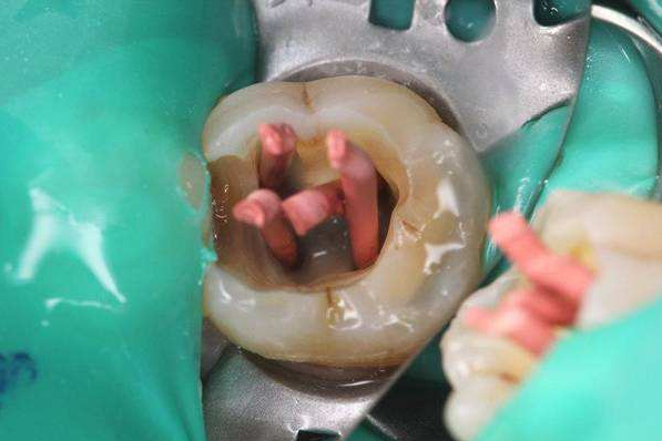 小心拖到后期只能根管治疗