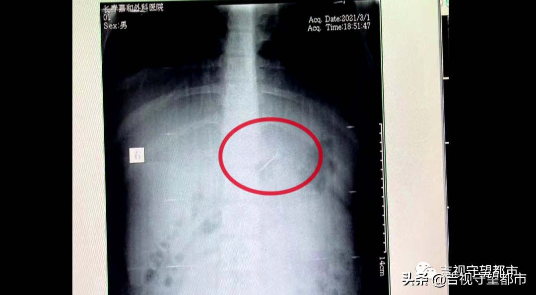 误吞4厘米钢钉，13岁“熊孩子”被紧急送医