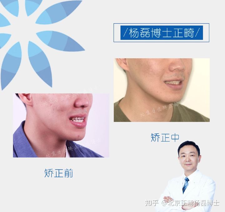 北京正畸杨磊博士：骨性反颌偏颌患者