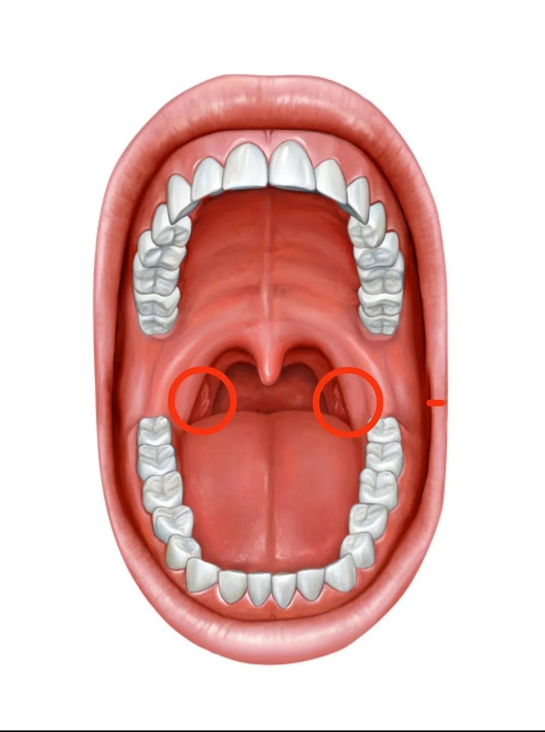 口腔扁桃体示意图扁桃体是位于我们口腔舌后根双侧的扁桃体窝类,看着
