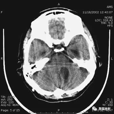 简明又详细的头部CT读片详解，收藏